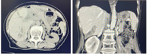 肝胆胰II科成功开展首例“超微创经皮肝穿刺肝内胆管碎石取石术”