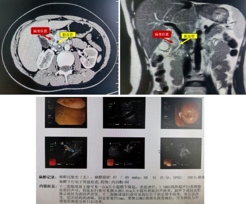 湘雅三医院多学科协作联合“拆弹” | 完成高难度十二指肠间质瘤局部切除术