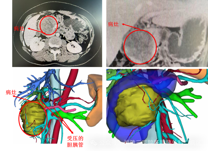 21岁女孩胰头长了9厘米肿瘤：为什么医生没有“一切了之”？